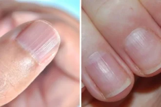 नाखूनों पर लकीरें: शरीर की अंदरूनी सेहत का संकेत, जानिए कारण और बचाव के उपाय