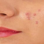 Pimples Home Remedies : गर्मियों में पिंपल्स से हो गए हैं परेशान, तो इन 5 असरदार घरेलू उपायों से पाएं साफ-सुथरी त्वचा