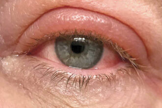 Conjunctivitis : गर्मी और बारिश में तेजी से फैल रही है 'पिंक आई', जानिए इसके लक्षण और बचाव के उपाय - Pink Eye