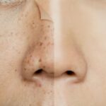 Skin Pigmentation : स्किन पिगमेंटेशन क्या है? कारण, लक्षण और बचाव की पूरी जानकारी