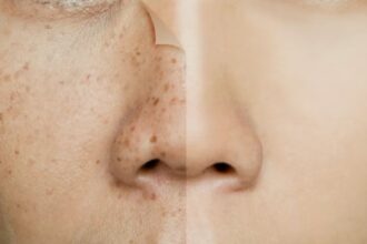 Skin Pigmentation : स्किन पिगमेंटेशन क्या है? कारण, लक्षण और बचाव की पूरी जानकारी