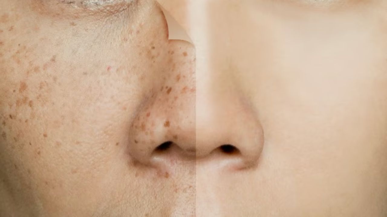 Skin Pigmentation : स्किन पिगमेंटेशन क्या है? कारण, लक्षण और बचाव की पूरी जानकारी