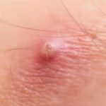 Boils Occur : बालतोड़ क्यों होता हैं? जानें लक्षण, कारण और घरेलू उपाय
