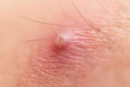 Boils Occur : बालतोड़ क्यों होता हैं? जानें लक्षण, कारण और घरेलू उपाय