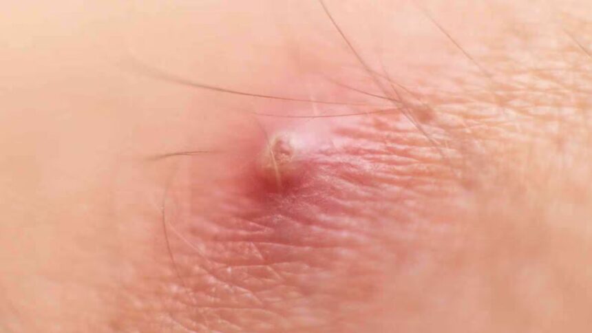 Boils Occur : बालतोड़ क्यों होता हैं? जानें लक्षण, कारण और घरेलू उपाय